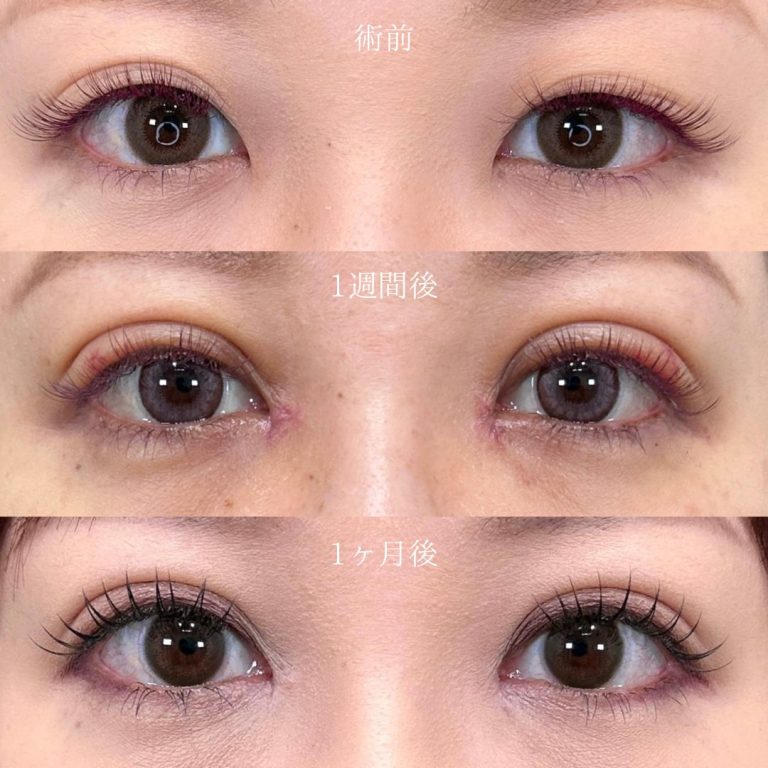二重埋没法(担当医:三好 翔輝 医師)の症例写真2