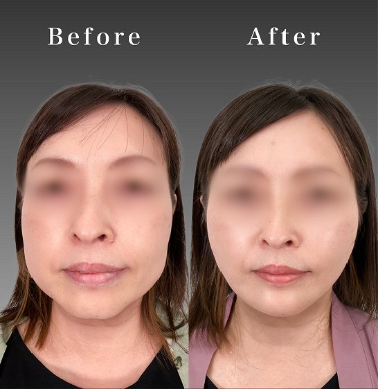 顔の脂肪吸引(担当医:岡本 卓也 医師)の症例写真1