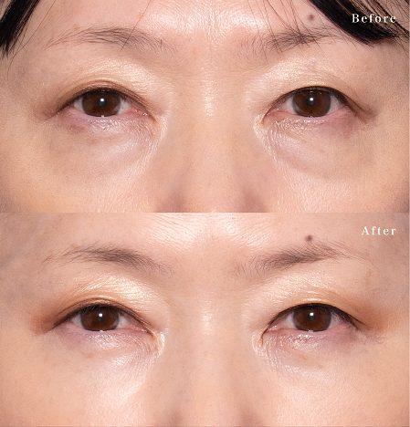 切らない目の下のクマ取り・目の下のたるみ（ふくらみ）取り(担当医:岡本 卓也 医師)の症例写真2