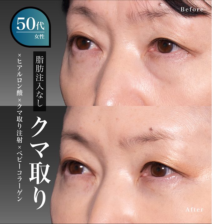 切らない目の下のクマ取り・目の下のたるみ（ふくらみ）取り(担当医:岡本 卓也 医師)の症例写真1
