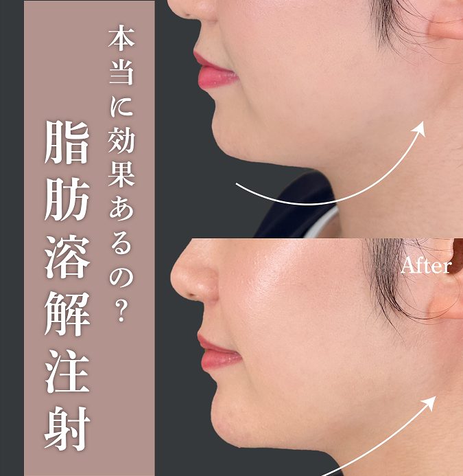 脂肪溶解注射（小顔・鼻・まぶた等部分痩せ注射）(担当医:岡本 卓也 医師)の症例写真1