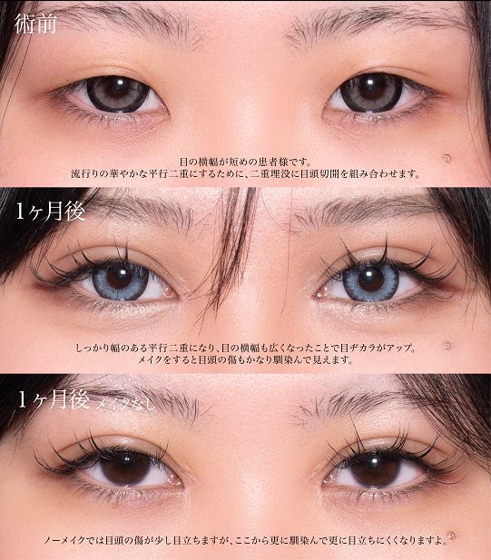 目頭切開(担当医:岡本 卓也 医師)の症例写真1