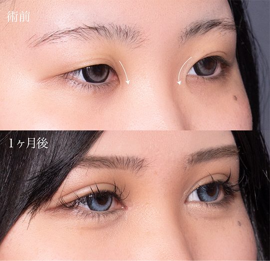 目頭切開(担当医:岡本 卓也 医師)の症例写真2
