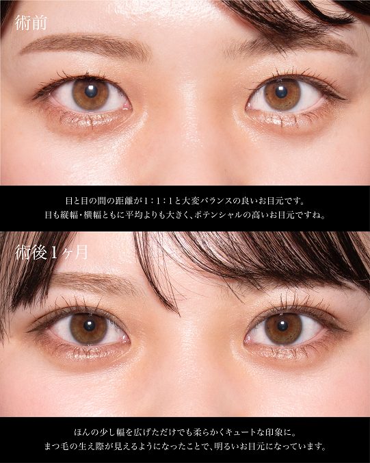 二重埋没法(担当医:岡本 卓也 医師)の症例写真1