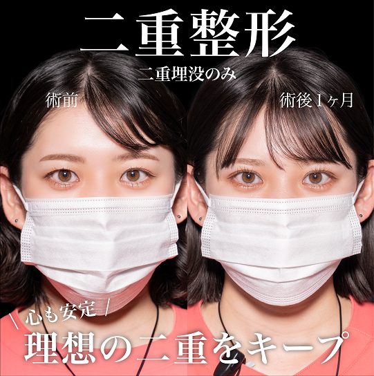 二重埋没法(担当医:岡本 卓也 医師)の症例写真2