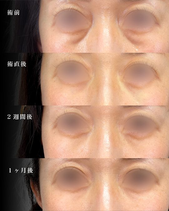 目の下（くぼみ）のヒアルロン酸注射(担当医:岡本 卓也 医師)の症例写真1