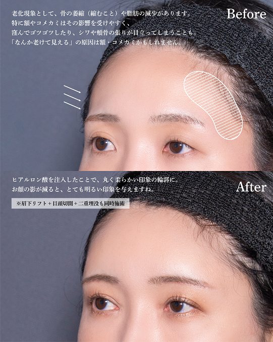 おでこ・こめかみのデザイン注射（ヒアルロン酸）(担当医:岡本 卓也 医師)の症例写真2