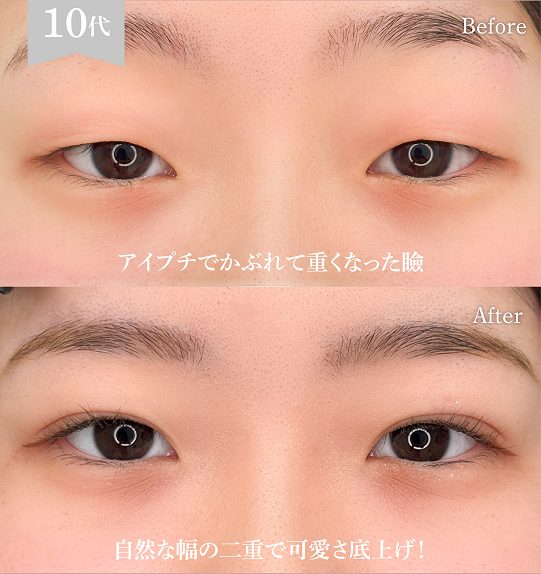 二重埋没法(担当医:岡本 卓也 医師)の症例写真1