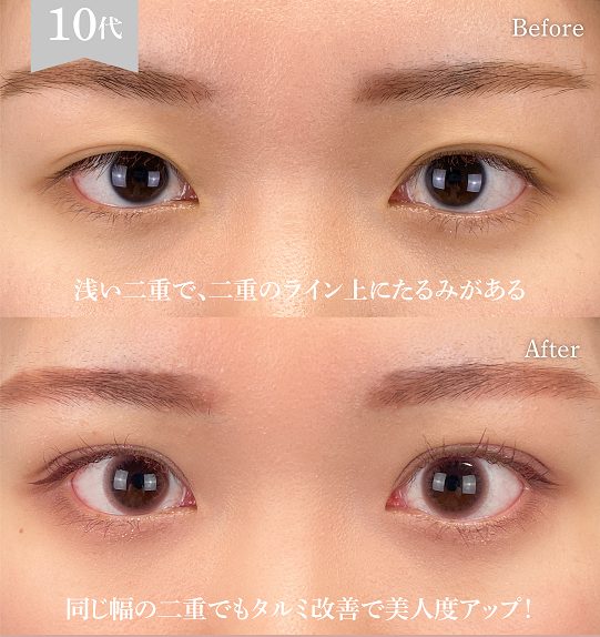 二重埋没法(担当医:岡本 卓也 医師)の症例写真1