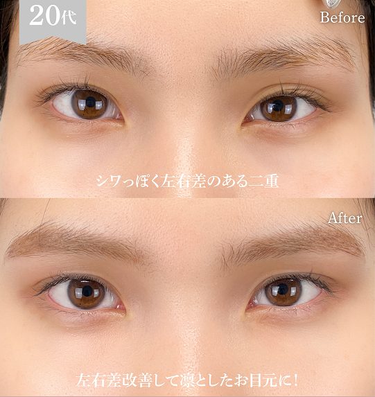 二重埋没法(担当医:岡本 卓也 医師)の症例写真1