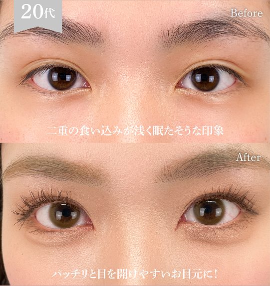 まぶたの脂肪取り(担当医:岡本 卓也 医師)の症例写真1