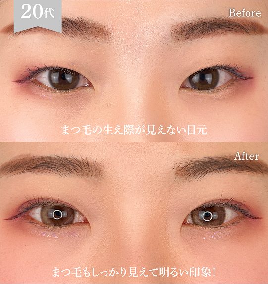二重埋没法(担当医:岡本 卓也 医師)の症例写真1