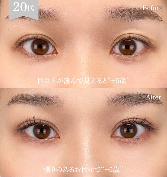 二重埋没法(担当医:岡本 卓也 医師)の症例写真1