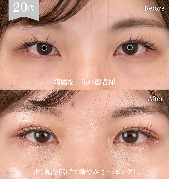 二重埋没法(担当医:岡本 卓也 医師)の症例写真1