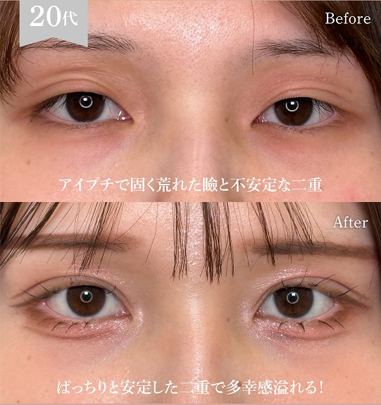 二重埋没法(担当医:岡本 卓也 医師)の症例写真1