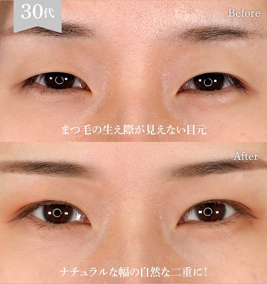 二重埋没法(担当医:岡本 卓也 医師)の症例写真1