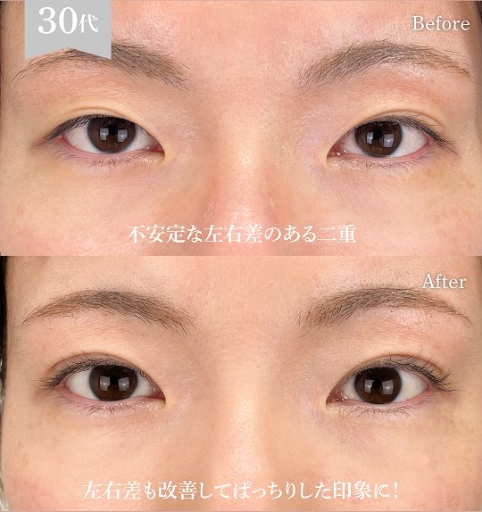 二重埋没法(担当医:岡本 卓也 医師)の症例写真1