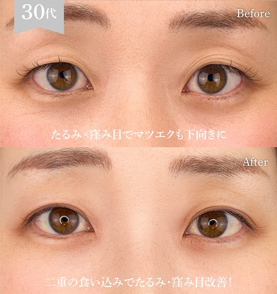 二重埋没法(担当医:岡本 卓也 医師)の症例写真1