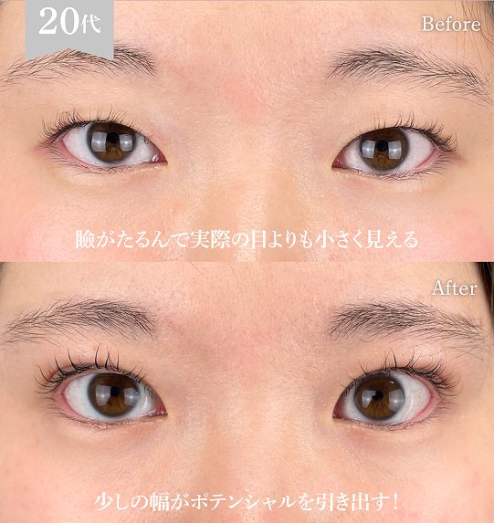 まぶたの脂肪取り(担当医:岡本 卓也 医師)の症例写真1