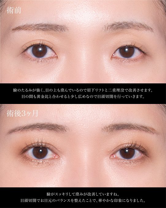 眉下切開（眉下リフト）(担当医:岡本 卓也 医師)の症例写真1