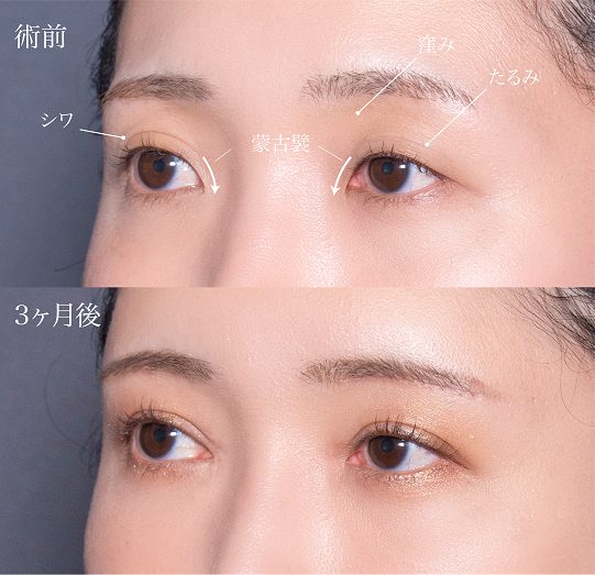 眉下切開（眉下リフト）(担当医:岡本 卓也 医師)の症例写真2