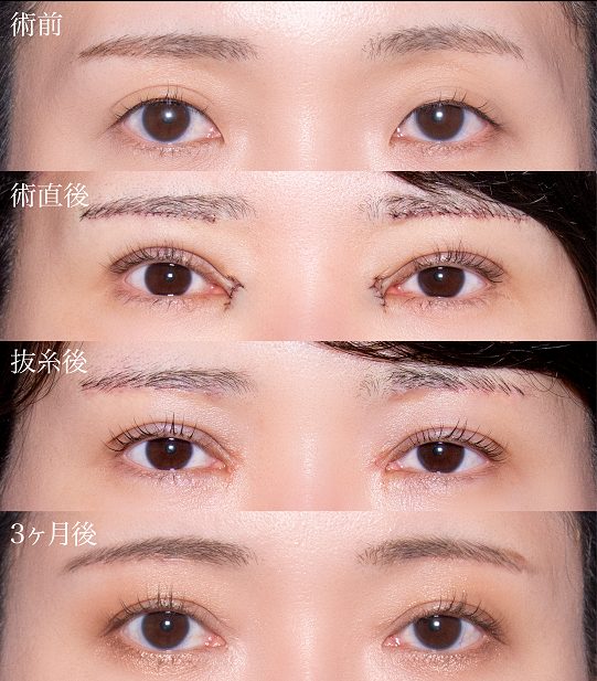 眉下切開（眉下リフト）(担当医:岡本 卓也 医師)の症例写真3