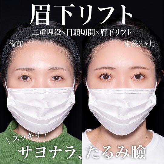 眉下切開（眉下リフト）(担当医:岡本 卓也 医師)の症例写真4