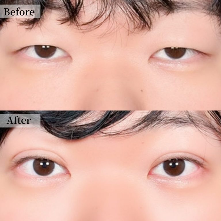 二重埋没法(担当医:山本 和範 医師)の症例写真1