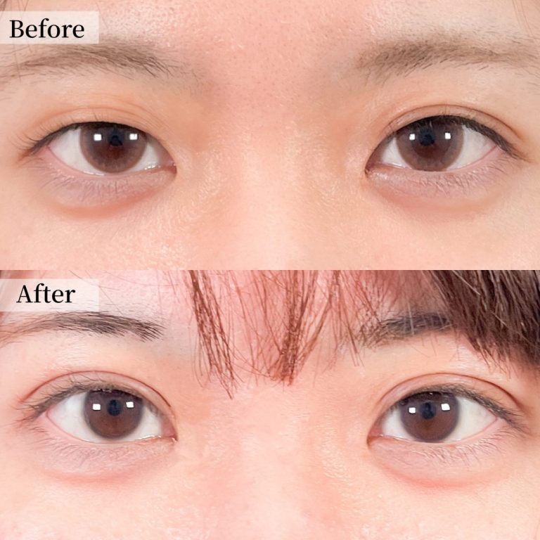 二重埋没法(担当医:山本 和範 医師)の症例写真1
