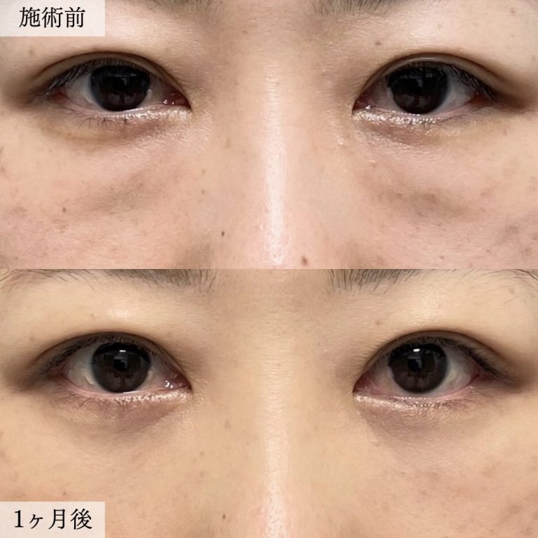 切らない目の下のクマ取り・目の下のたるみ（ふくらみ）取り(担当医:大見 貴秀 医師)の症例写真2