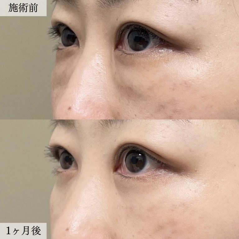 切らない目の下のクマ取り・目の下のたるみ（ふくらみ）取り(担当医:大見 貴秀 医師)の症例写真1