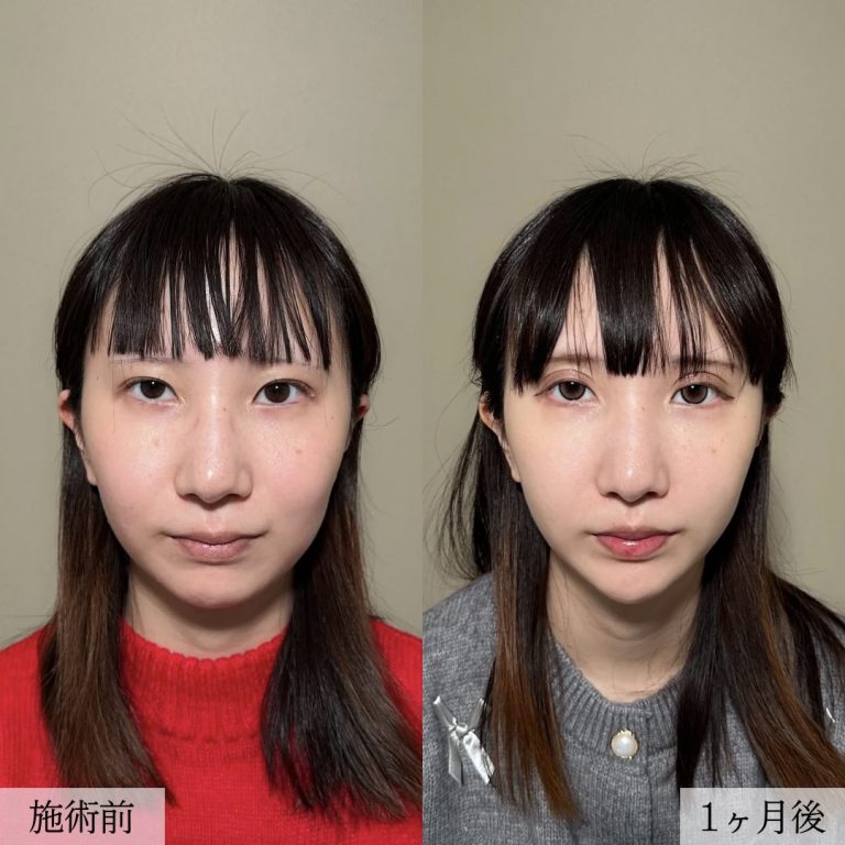 顔の脂肪吸引(担当医:大見 貴秀 医師)の症例写真1