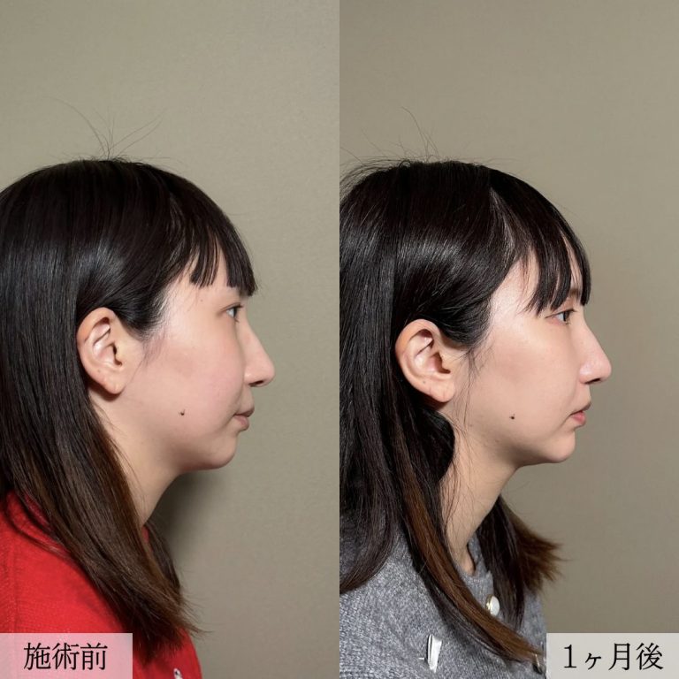 顔の脂肪吸引(担当医:大見 貴秀 医師)の症例写真2