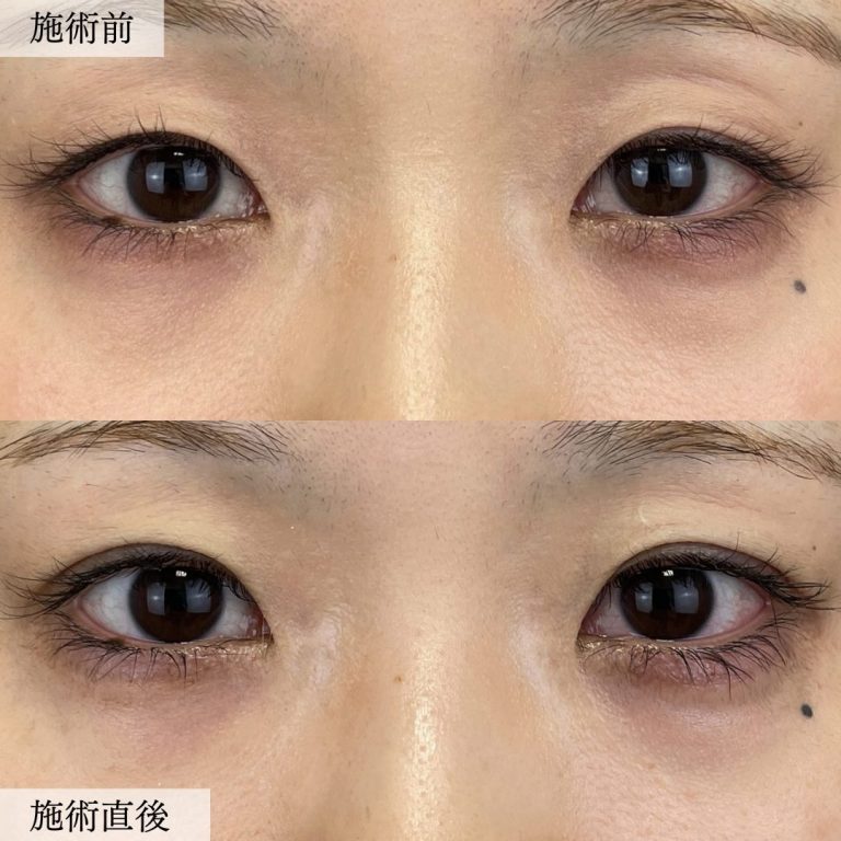 二重埋没法(担当医:大見 貴秀 医師)の症例写真1
