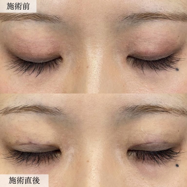二重埋没法(担当医:大見 貴秀 医師)の症例写真2