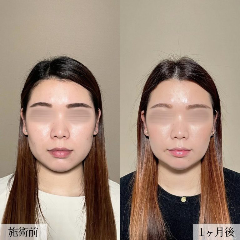 顔の脂肪吸引(担当医:大見 貴秀 医師)の症例写真2
