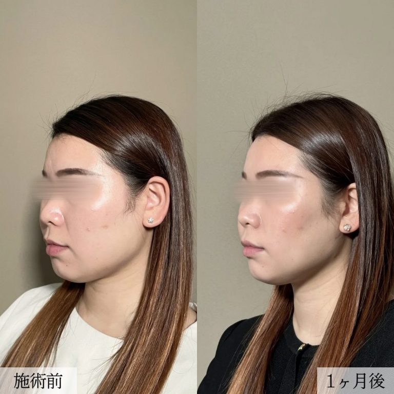 顔の脂肪吸引(担当医:大見 貴秀 医師)の症例写真1