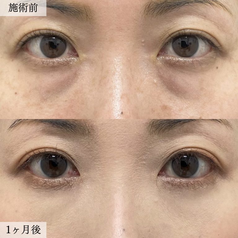 切らない目の下のクマ取り・目の下のたるみ（ふくらみ）取り(担当医:大見 貴秀 医師)の症例写真1