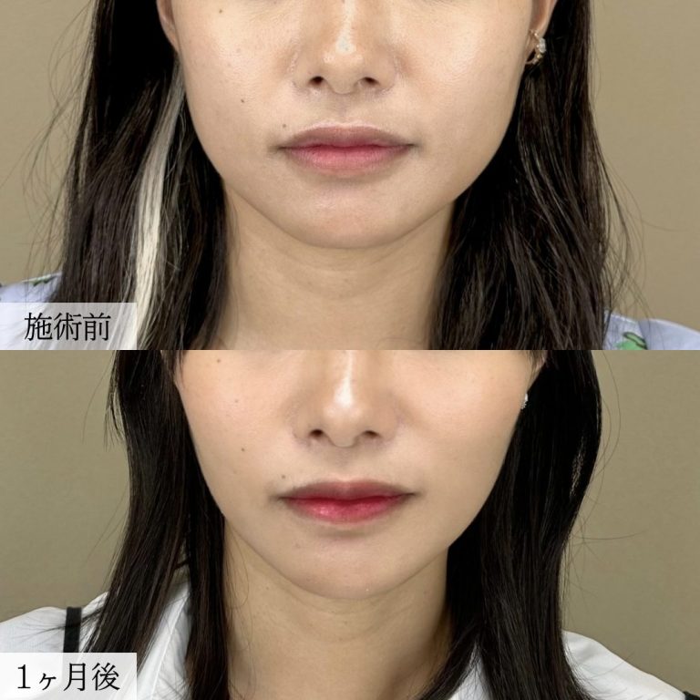 顔の脂肪吸引(担当医:大見 貴秀 医師)の症例写真1