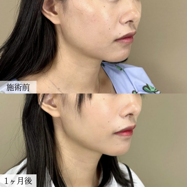 顔の脂肪吸引(担当医:大見 貴秀 医師)の症例写真2