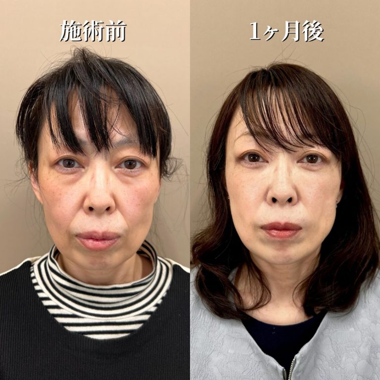 切らない目の下のクマ取り・目の下のたるみ（ふくらみ）取り(担当医:花岡 拓也 医師)の症例写真1