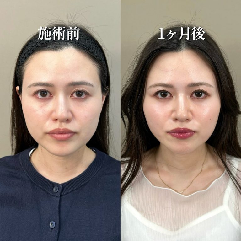 小顔美肌再生（リフトアップ）(担当医:花岡 拓也 医師)の症例写真1