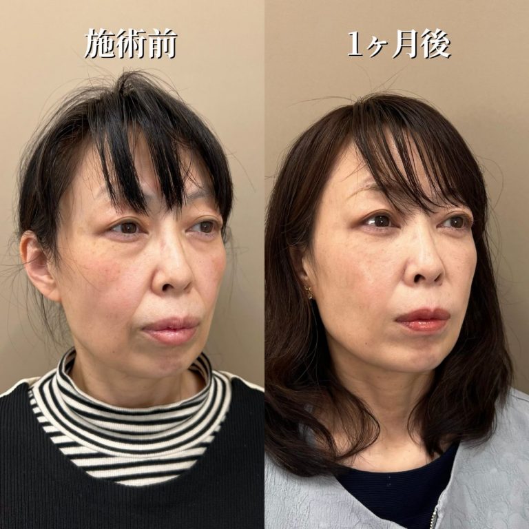 切らない目の下のクマ取り・目の下のたるみ（ふくらみ）取り(担当医:花岡 拓也 医師)の症例写真2