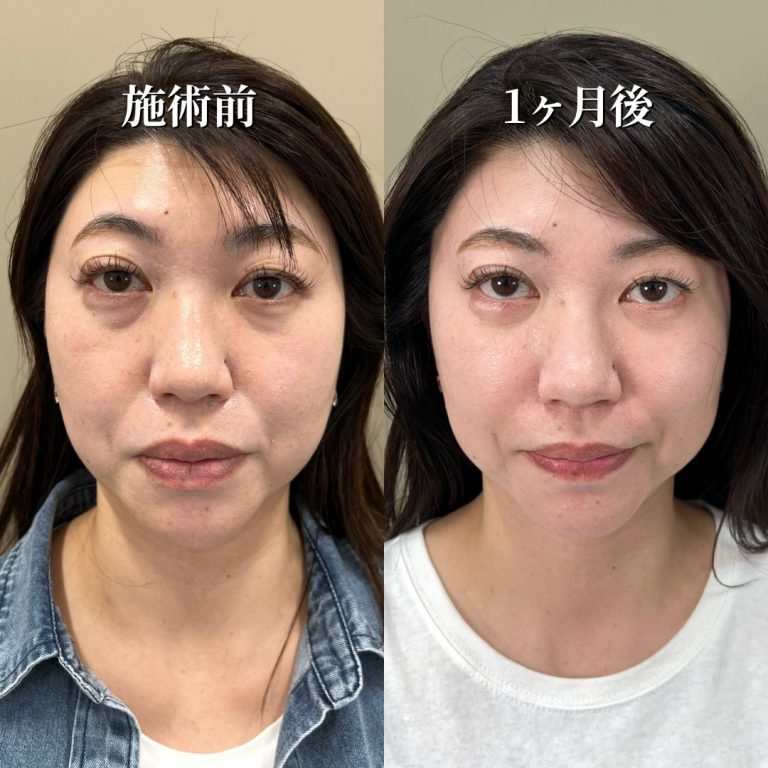 切らない目の下のクマ取り・目の下のたるみ（ふくらみ）取り(担当医:花岡 拓也 医師)の症例写真1