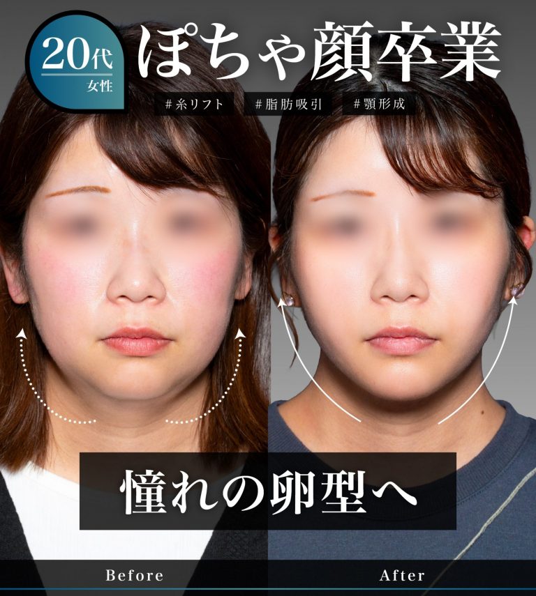顔の脂肪吸引(担当医:岡本 卓也 医師)の症例写真2