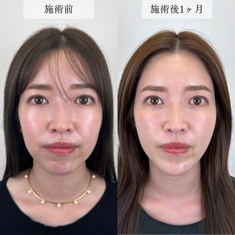顔の脂肪吸引(担当医:富田 秀鷹 医師)の症例写真1