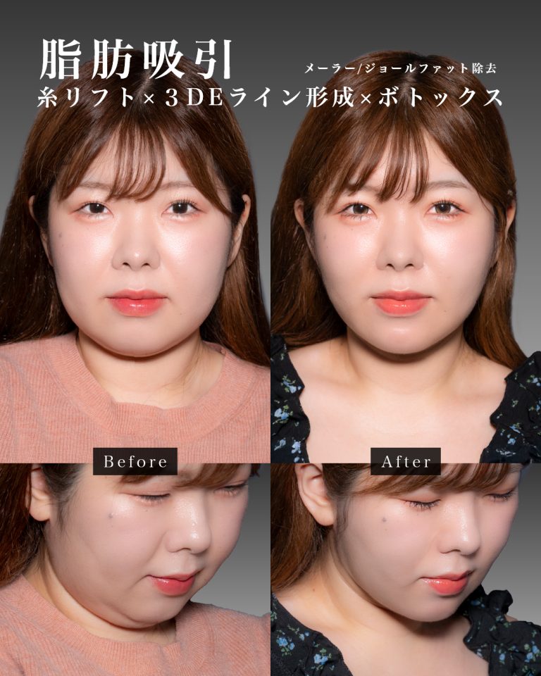 顔の脂肪吸引(担当医:岡本 卓也 医師)の症例写真1