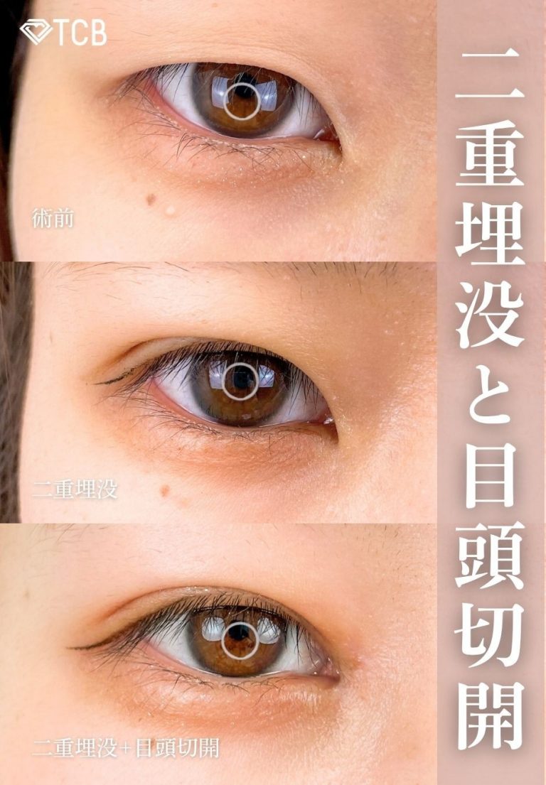 目頭切開(担当医:岡本 卓也 医師)の症例写真2