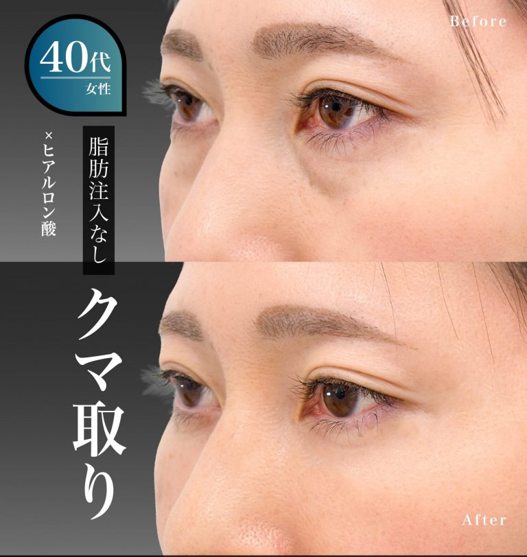 切らない目の下のクマ取り・目の下のたるみ（ふくらみ）取り(担当医:岡本 卓也 医師)の症例写真2