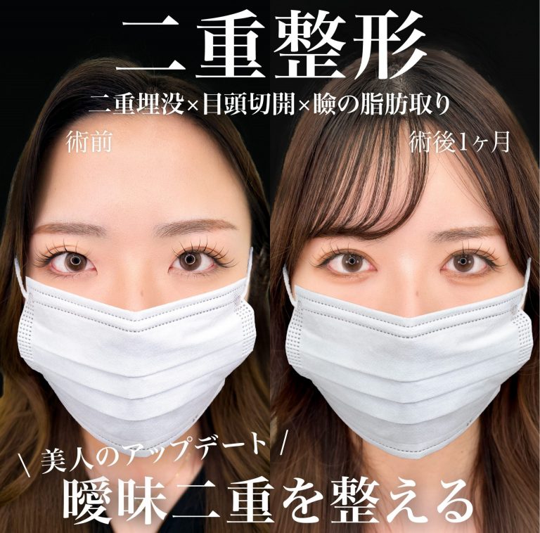 目頭切開(担当医:岡本 卓也 医師)の症例写真2